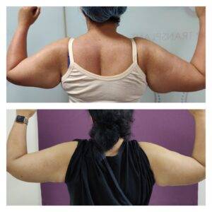 Arm Lift Procedure (Brachioplasty) 1