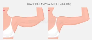 Arm lift surgery reference image