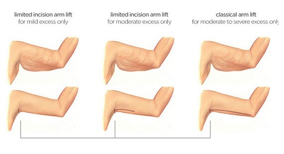 Brachioplasty surgery