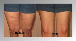 Thigh Lift in Bangalore - Thighplasty Cost 1 thighplasty cost