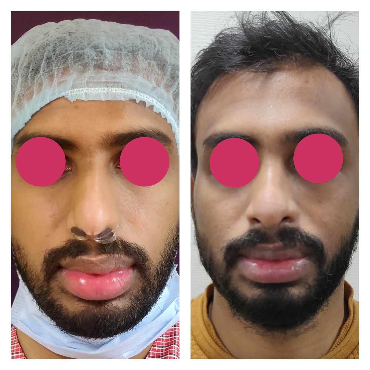 Lip Reduction Surgery