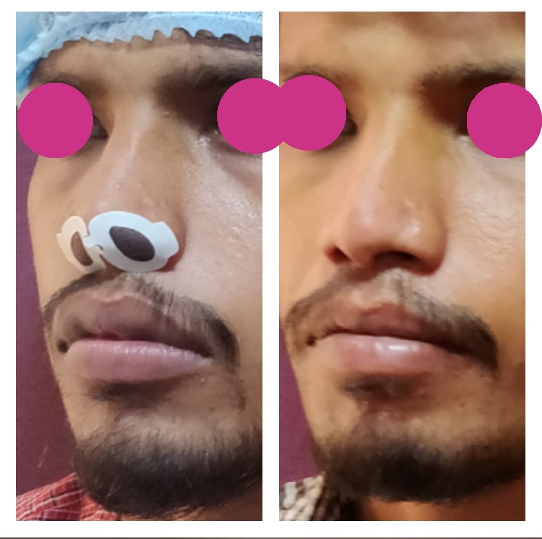 Lip Reduction Surgery