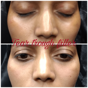 Dermal Filler Treatment 5