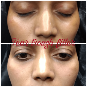 Dermal Filler Treatment 2