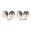 Hair Transplant Cost in Bangalore 3