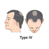 Hair Transplant Cost in Bangalore 4