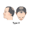 Hair Transplant in Bangalore 6