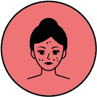 Acne skin treatments at The Venkat Center