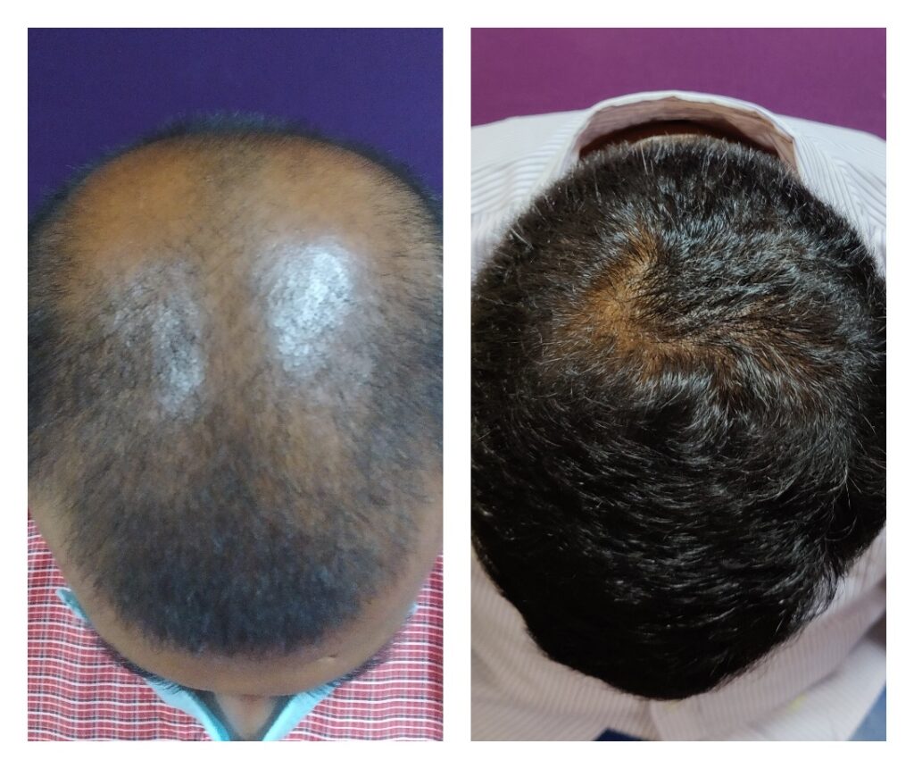 crown hair transplant