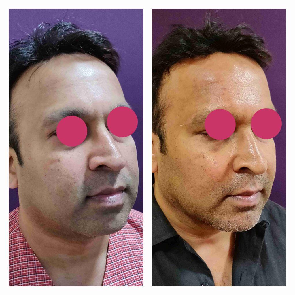 Chin augmentation with fat grafting at Venkat Center, Bangalore