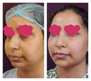 chin augmentation in bangalore