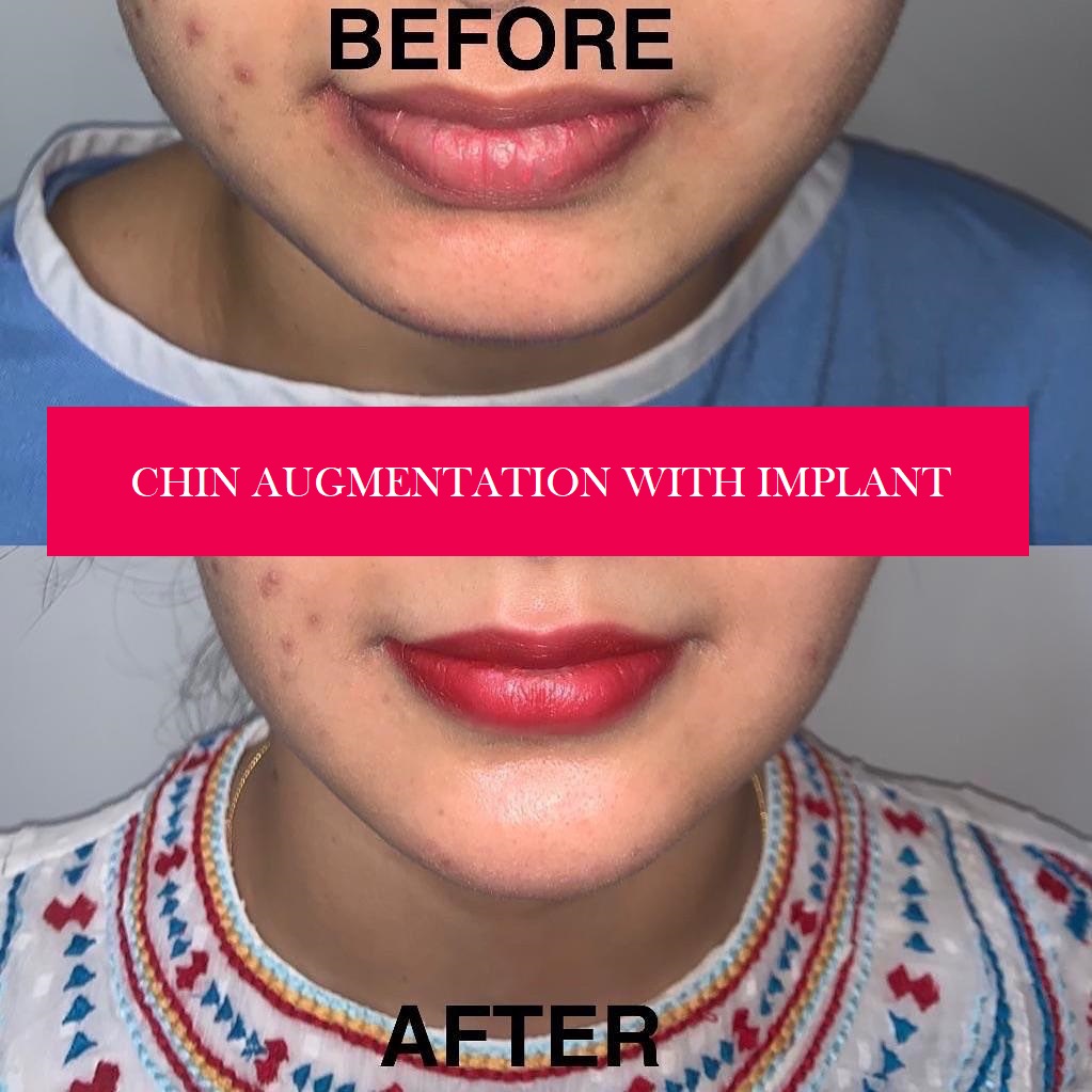 Chin augmentation with implant