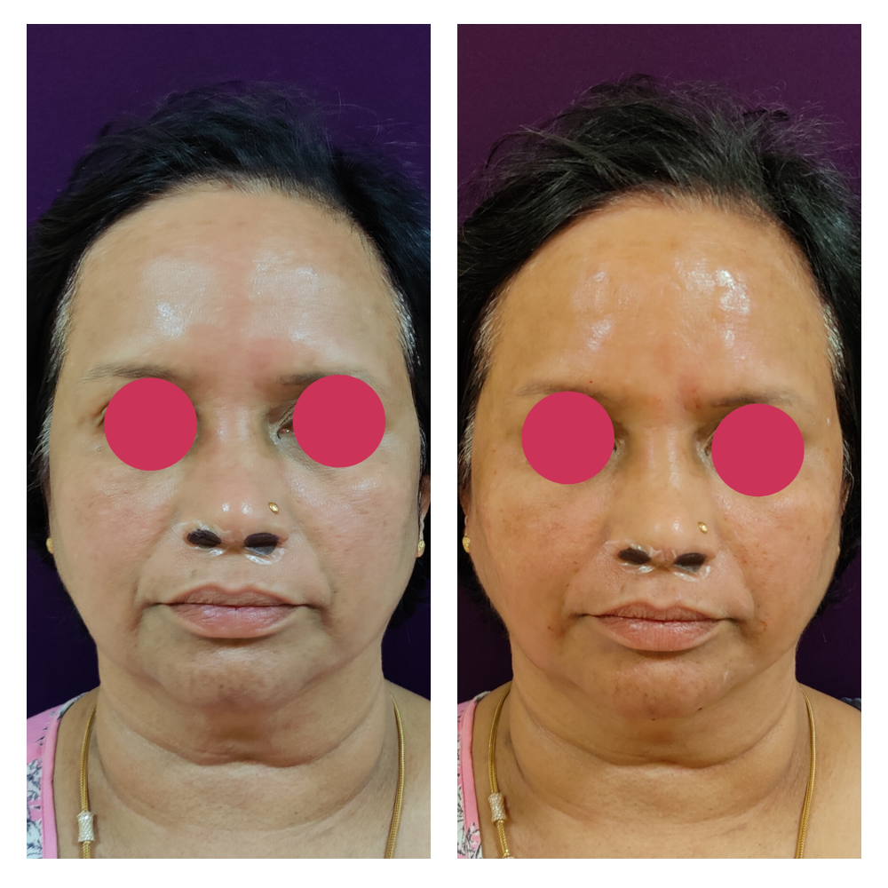 Dermal Filler Treatment 3