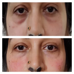 Dermal Filler Treatment 25 Fillers Surgery results at Venkat Center, Bangalore