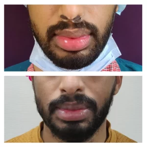 Results of Lip Reduction Surgery at Venkat Center Bangalore