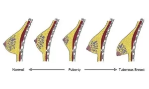 how-do-i-know-if-i-have-tubular-breasts