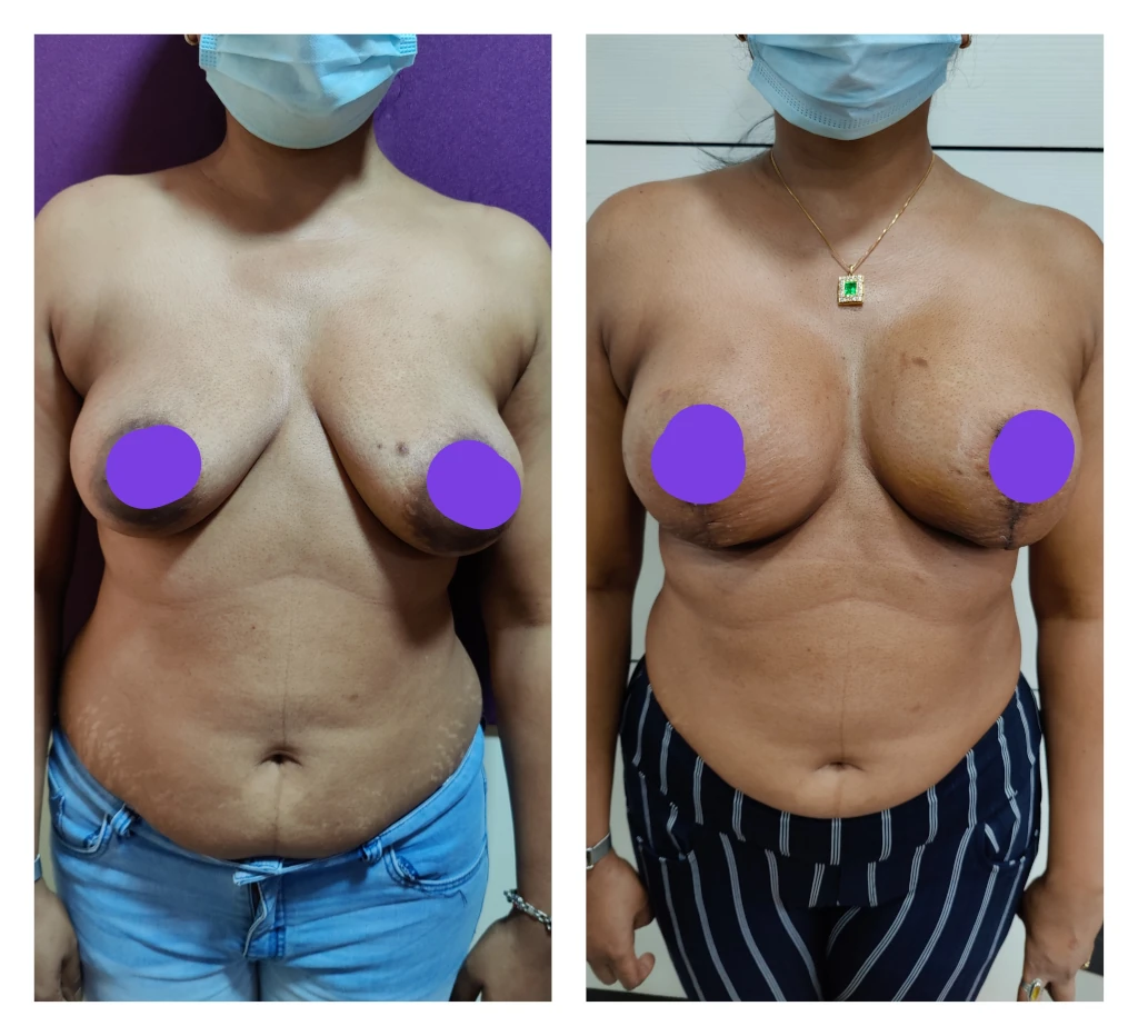 Breast Augmentation Surgery  Breast Implant Surgery Mangalore