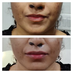 Dermal filler results - at Venkat Center, Bangalore