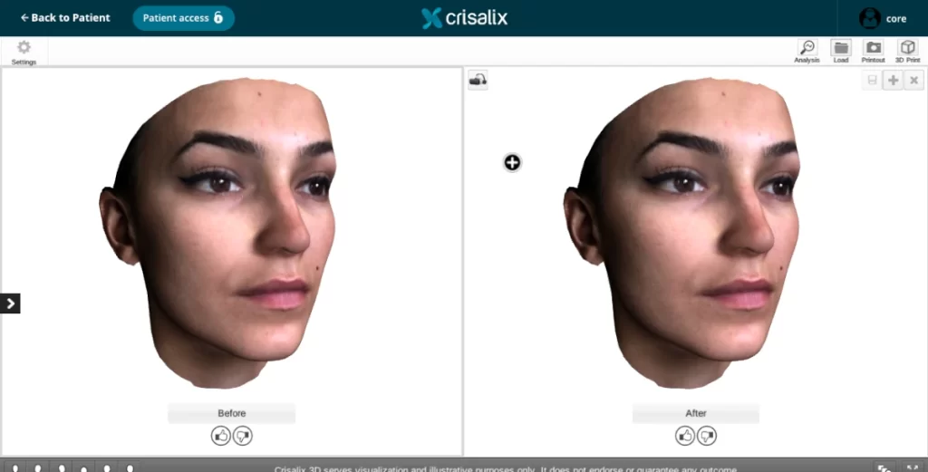 Crisalix 3D face Maria - at Venkat Center, Bangalore