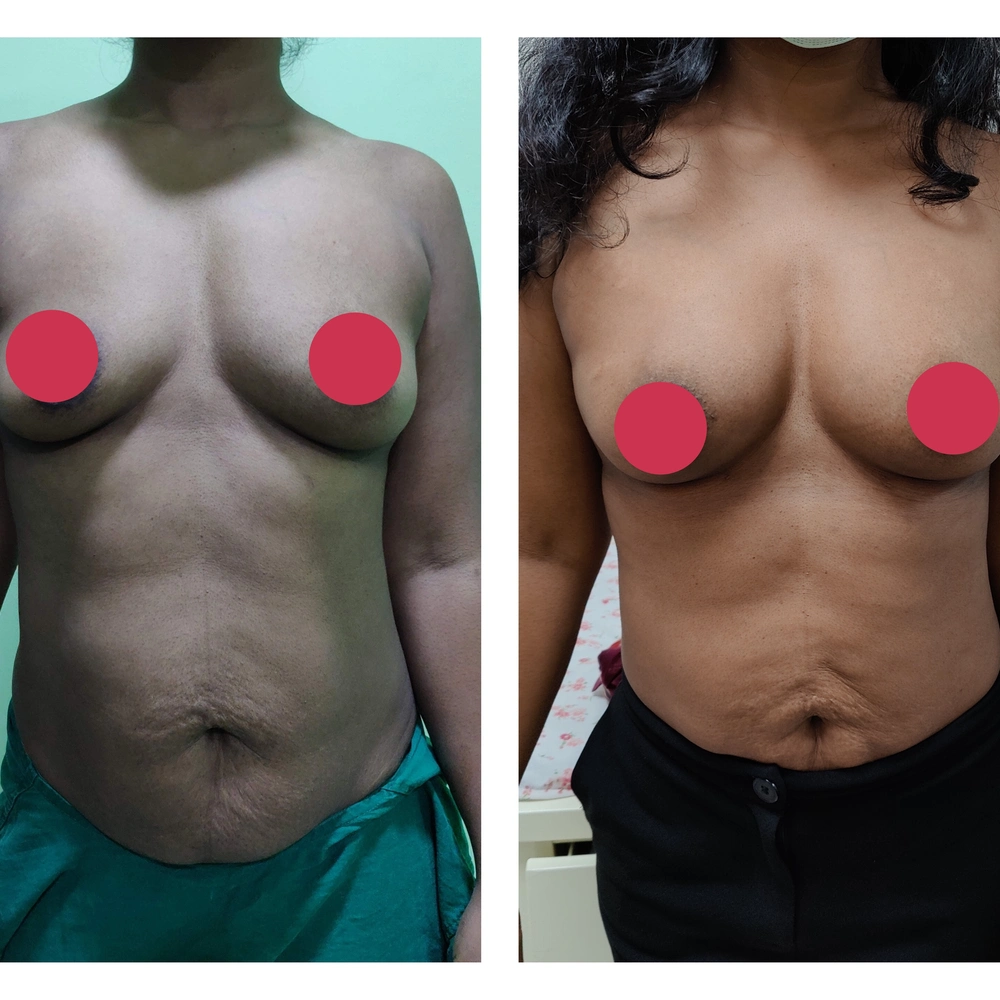 Breast Treatment