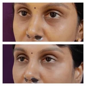 Under Eye FIller Treatment