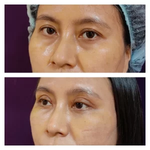 Under Eye FIller Treatment