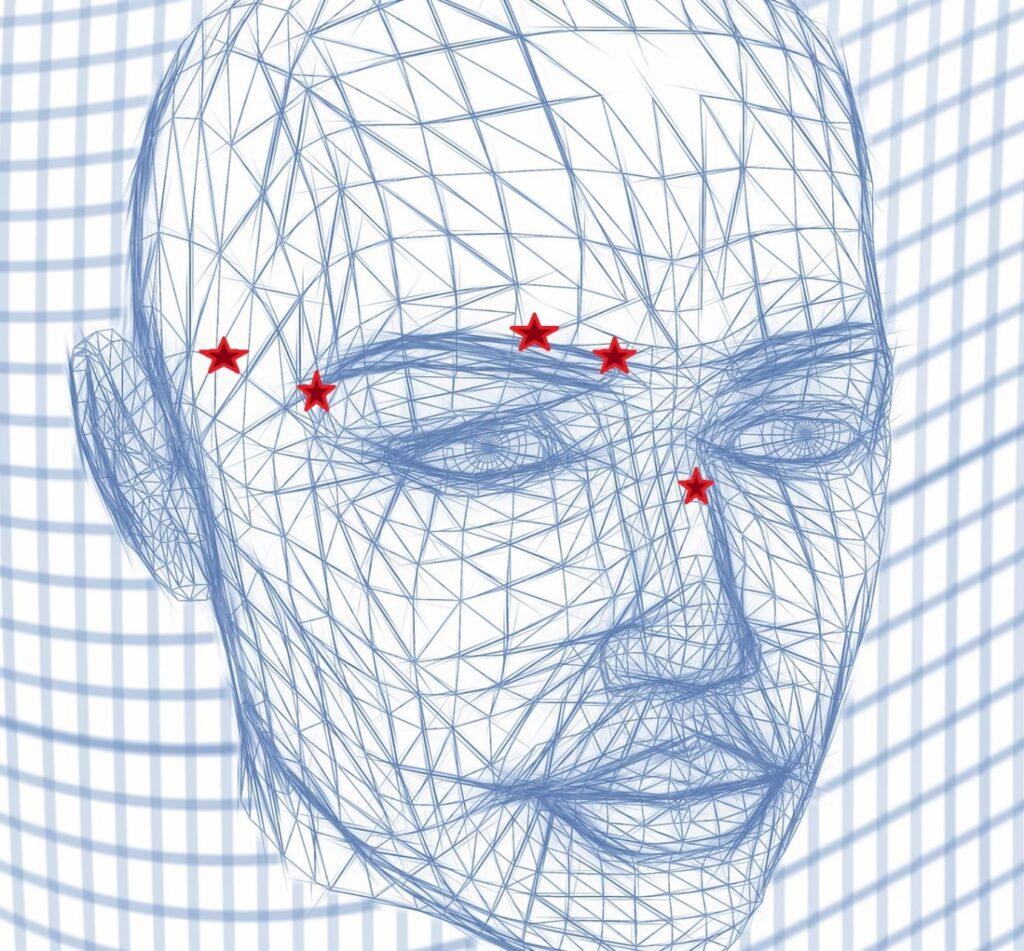Migraine Surgery 3 Migraine Surgery 2