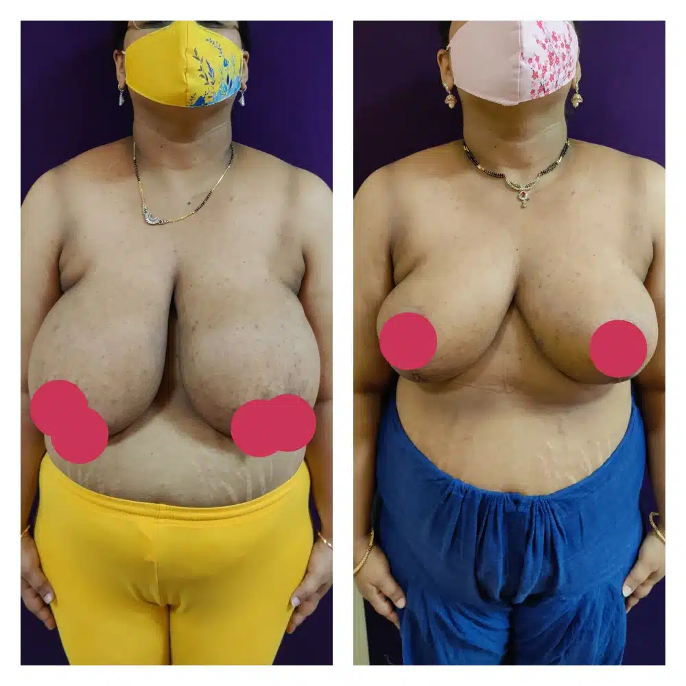 Best Female Breast Reduction Surgery Cost in Delhi India