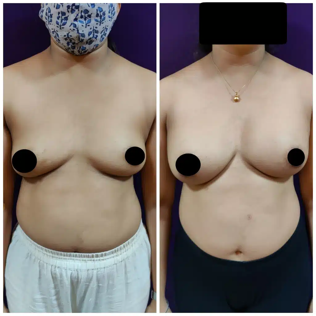 Breast Implants at Venkat Center Bangalore Mar 23 2