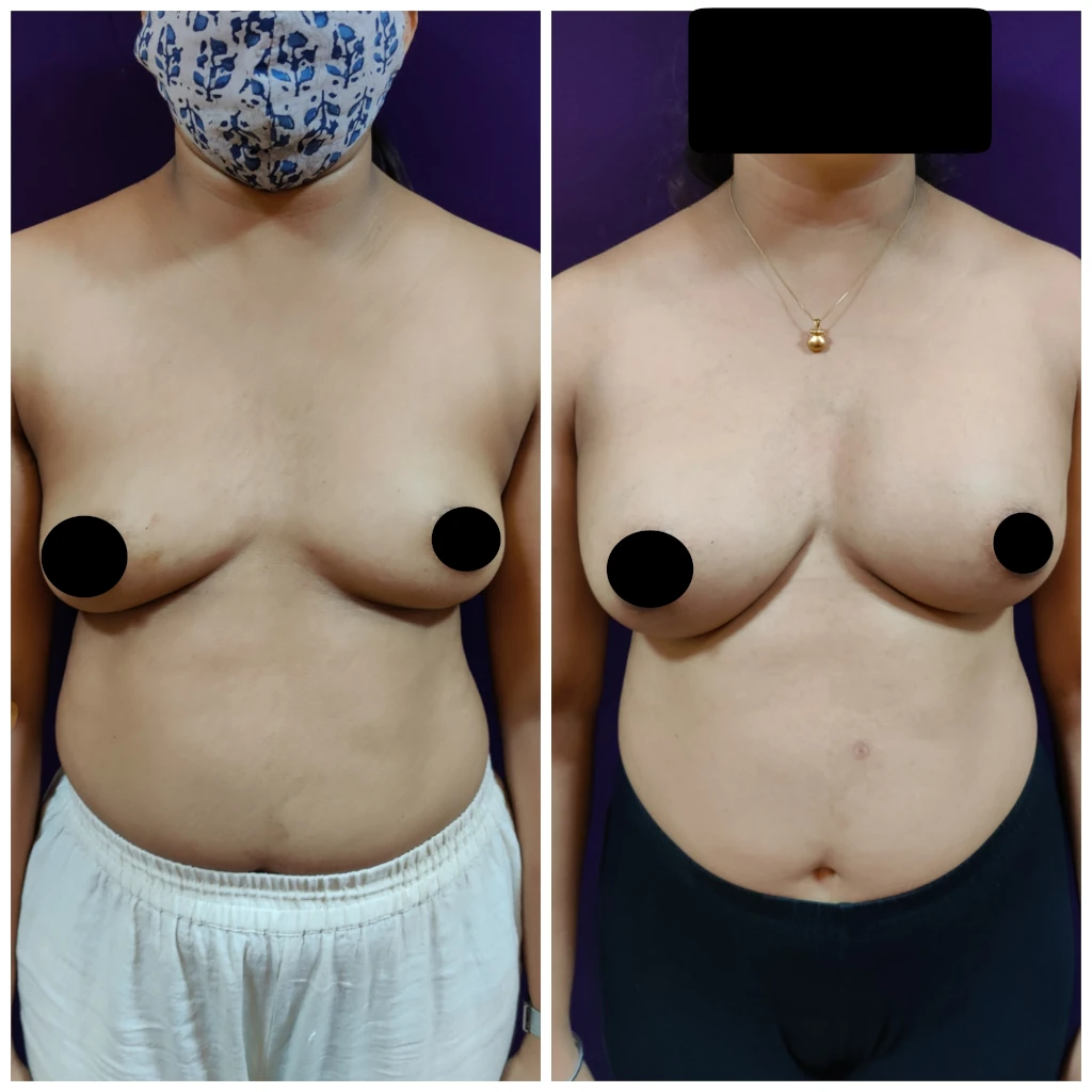 Breast Implants at Venkat Center Bangalore Mar 23 2