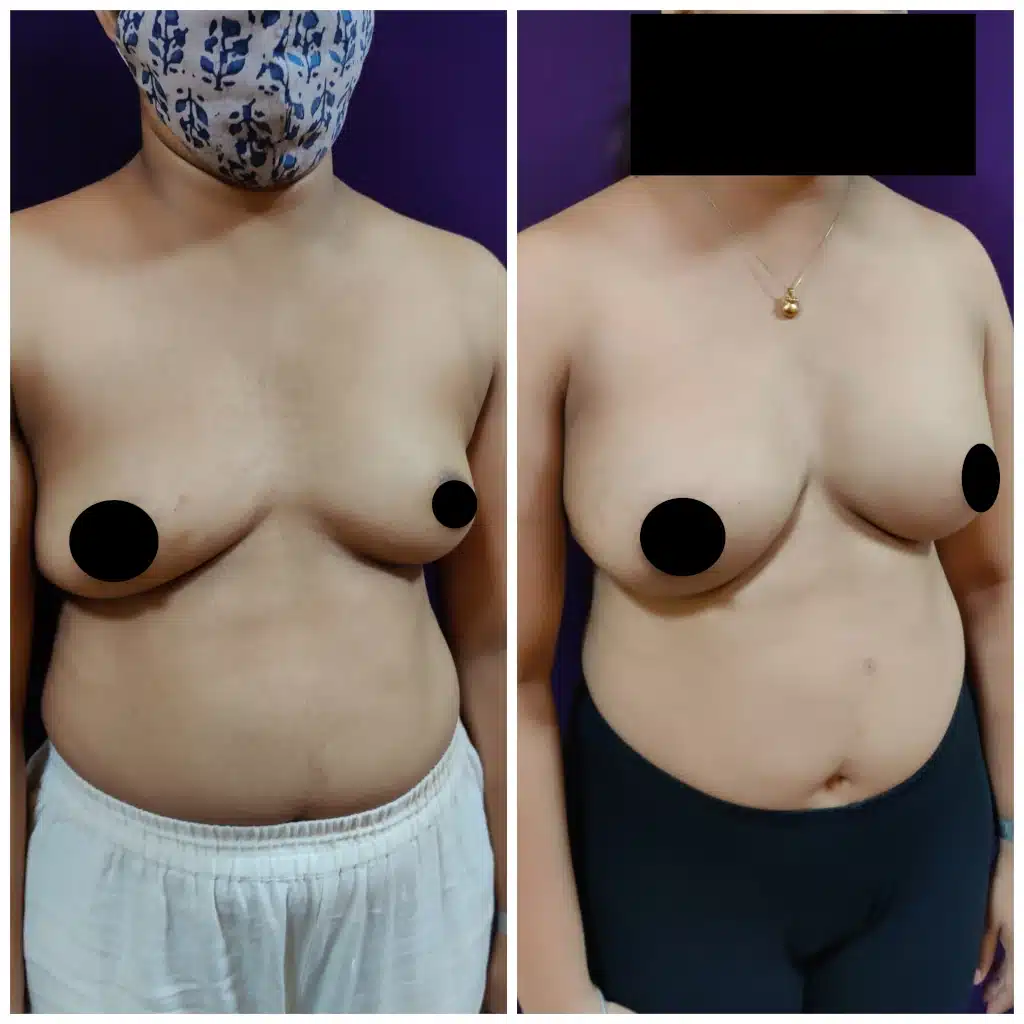 Breast Implants at Venkat Center Bangalore Mar 23