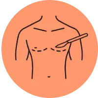 Liposuction in Bangalore 1