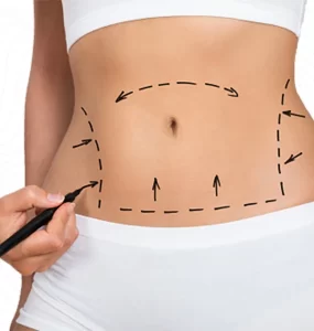 liposuction in bangalore