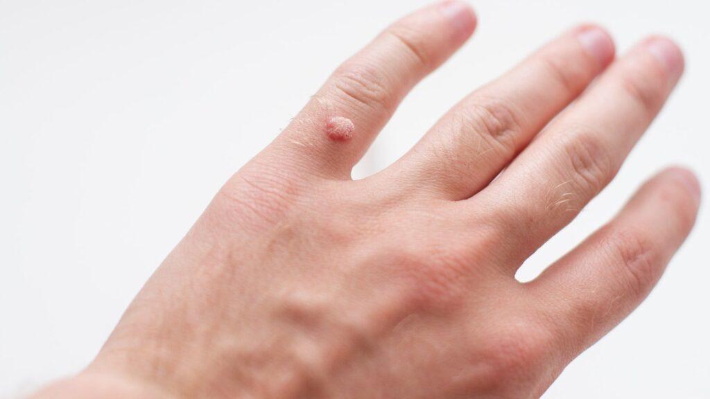 viral warts treatment