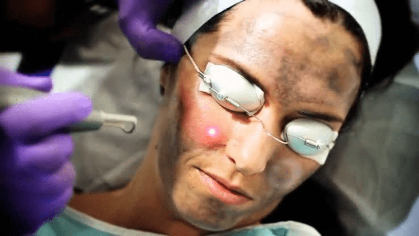 Fractional laser treatment for melasma