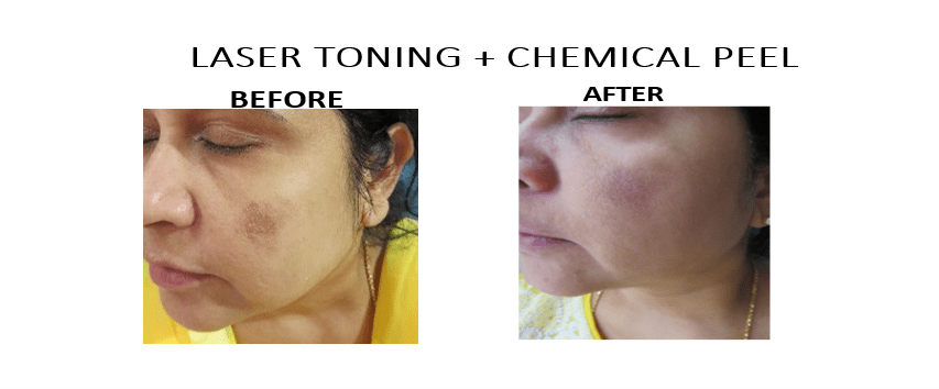 Melasma or Pigmentation Treatment 1