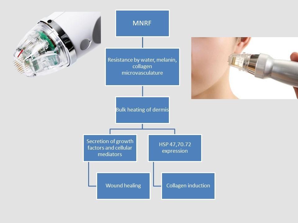 microneedling radio frequency