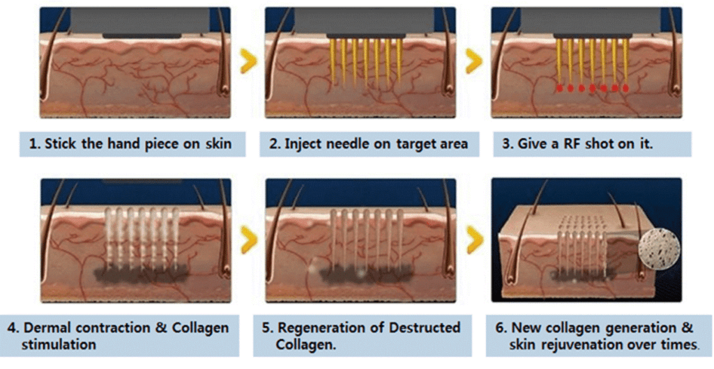 mnrf treatment