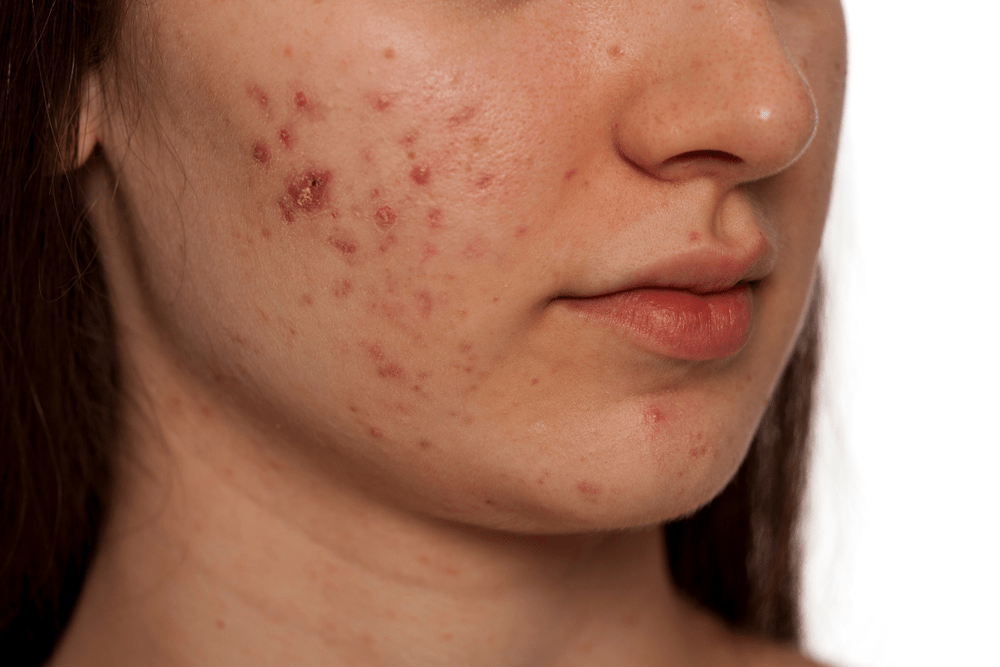 acne treatment in bangalore