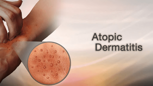 atopic dermatitis treatment