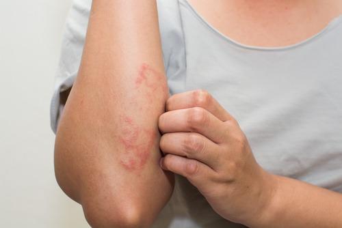 what is eczema