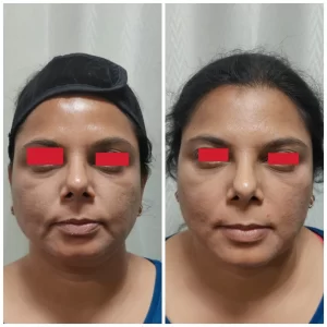 Filler Treatment Result at Venkat Center Bangalore 1