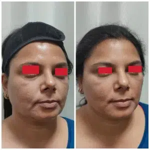 Filler Treatment Result at Venkat Center Bangalore 2