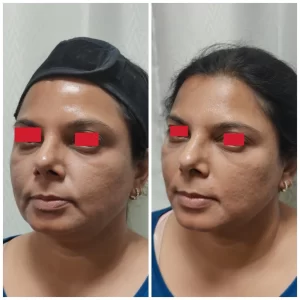 Filler Treatment Result at Venkat Center Bangalore 3