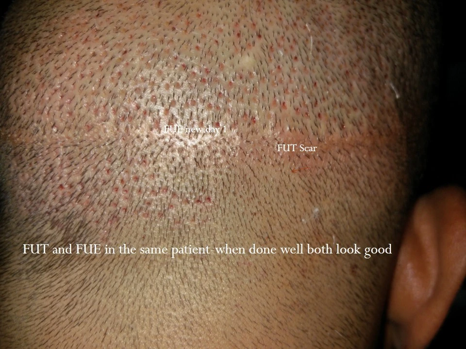 FUE vs FUT