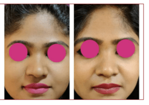 Rhinoplasty Cost in Bangalore 3