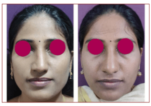 Rhinoplasty Cost in Bangalore 2