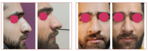 Rhinoplasty Cost in Bangalore 5