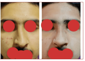 Rhinoplasty Cost in Bangalore 1