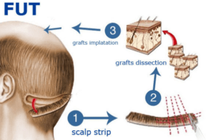 Introduction to Hair Transplant 3